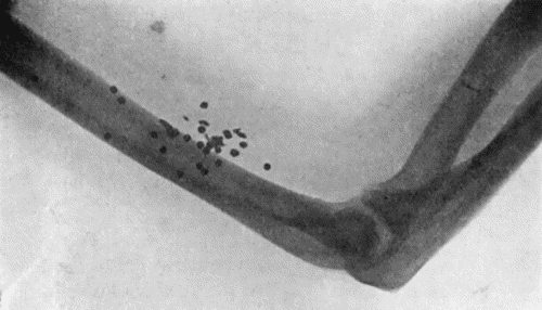 Fig. 62.—Radiogram showing Pellets embedded in Arm. (Mr. J.W. Dowden's case.)
