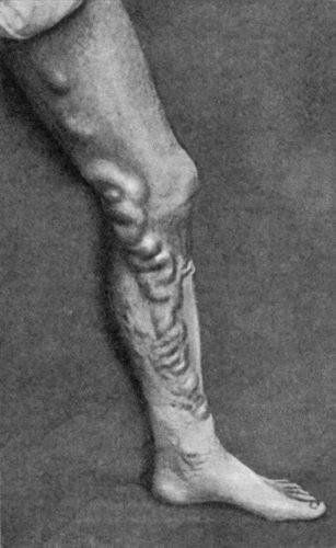 Fig. 67.—Extensive Varix of Internal Saphena System on Left Leg, of many years' standing.
