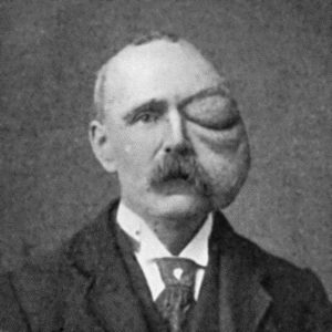 Fig. 70.—Cirsoid Aneurysm of Orbit and Face, which developed after a blow on the Orbit with a cricket ball. (From a photograph lent by Sir Montagu Cotterill.)