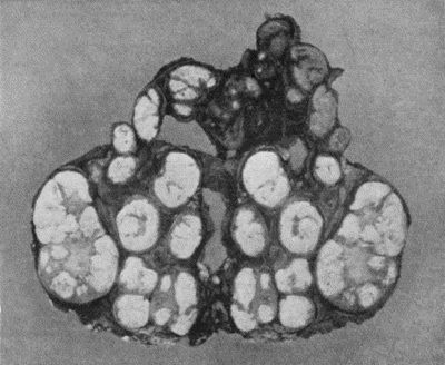 Fig. 78.—Mass of Tuberculous Glands removed from Axilla (cf. Fig. 79).