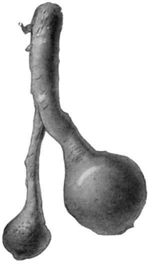 Fig. 84.—Stump Neuromas of Sciatic Nerve, excised forty years after the original amputation by Mr. A.G. Miller.