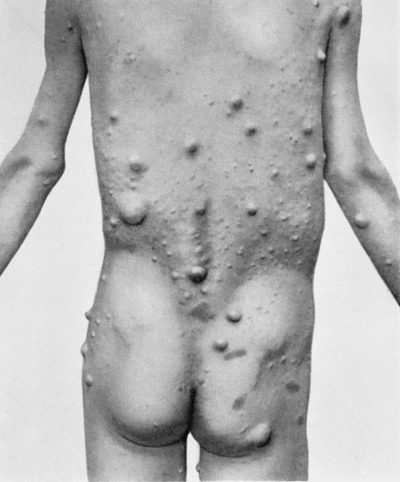 Fig. 88.—Multiple Neuro-fibromas of Skin (Molluscum fibrosum, or Recklinghausen's disease).