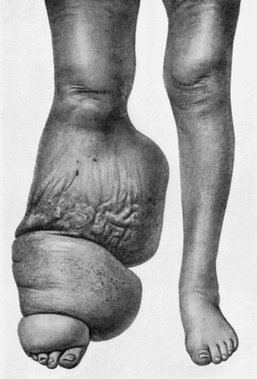 Fig. 97.—Elephantiasis in a woman æt. 45.