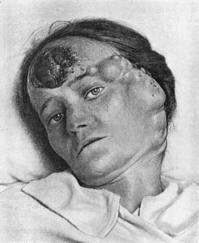 Fig. 105.—Melanotic Cancer of Forehead with Metastases in Lymph Vessels and Glands.