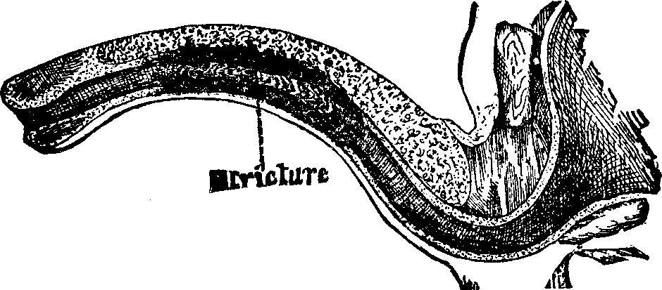 Illustration:
Fig. 4. Condition of the urethra in Case 112,289; permanently cured at the
Invalids' Hotel and Surgical Institute.