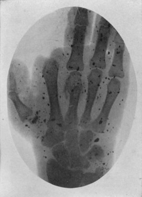 THIS X-RAY PHOTOGRAPH IS THAT OF A HAND OF A SOLDIER WOUNDED IN THE GREAT WAR