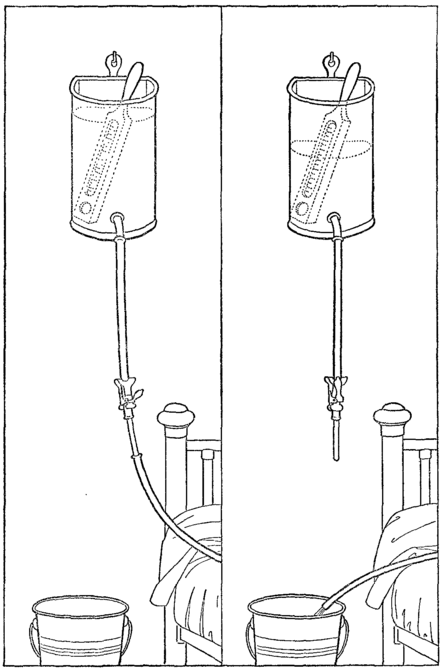 Fig. 15. The Cooling Enema.