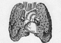 The Lungs and Heart of a boy who died from the effects of cigarette smoking.