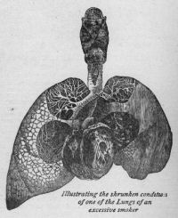 Lung of an excessive smoker.