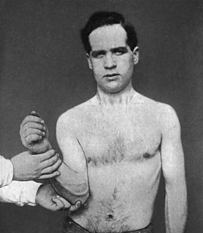 Fig. 21.—Kocher's Method—Second Movement; Elbow
carried forward, upward, and towards the Middle Line.