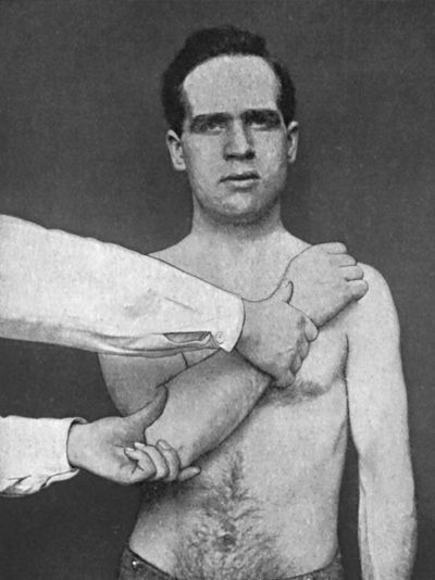 Fig. 22.—Kocher's Method—Third Movement; Rotation of
Arm towards Middle Line.