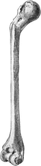 Fig. 27.—Fracture of Surgical Neck of Humerus, united
with Angular Displacement.