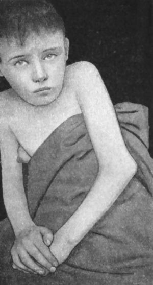 Fig. 36.—Backward Dislocation of Elbow, in a boy æt.
10, caused by a fall off a wall, landing on the elbow.