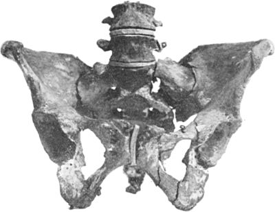 Fig. 55.—Multiple Fracture of Pelvis through
Horizontal and Descending Rami of both Pubes, and Longitudinal
Fracture of left side of Sacrum.