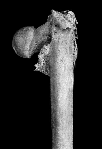 Fig. 68.—Non-impacted Fracture through Base of Neck.
Union has occurred with diminution of angle of neck—Coxa Vara.