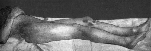 Fig. 72.—Dislocation of Right Femur on to Dorsum
Ilii.