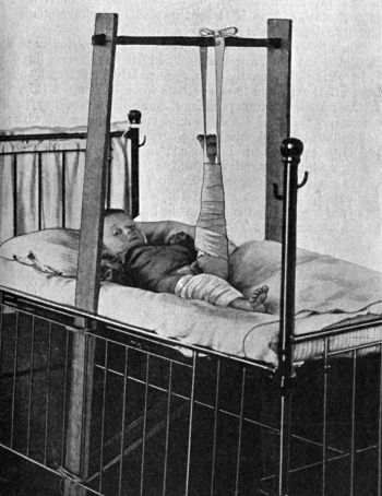 Fig. 79.—Fracture of Thigh treated by Vertical
Extension.