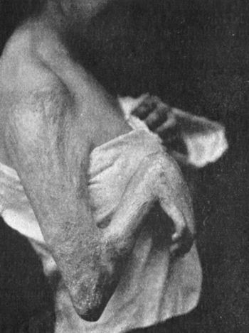 Fig. 107.—Contracture of Elbow and Wrist following a
burn in childhood. Treated by resection of both joints, and the
insertion, on the palmar aspect of each, of a flap from the abdominal
wall.