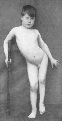 Fig. 114.—Tuberculous Disease of Left Hip: third
stage, showing adduction and shortening.