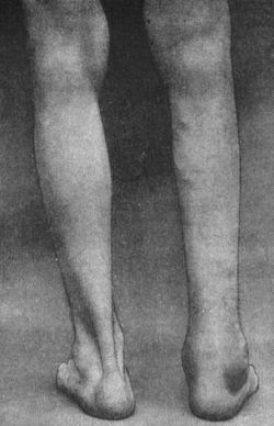 Fig. 126.—Tuberculous Disease in a man æt. 35, of six
weeks' duration.