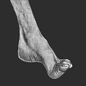 Fig. 150.—Pes Cavus in association with Pes Equinus,
the result of Poliomyelitis.