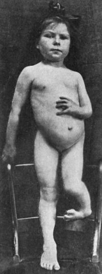 Fig. 170.—Congenital absence of Left Radius and Tibia
in a child æt. 8.