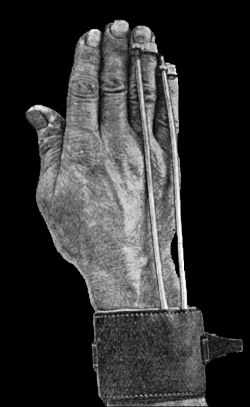 Fig. 174.—Splint used after Operation for Dupuytren's
Contraction.