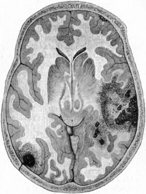 Fig. 184.—Contusion and Laceration of Brain. Note
limited lesion at point of impact on left side, and more extensive
damage at point of contre-coup on right.