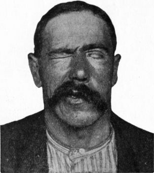 Fig. 201.—Patient suffering from left facial
Paralysis. Note smoothness of left side of face, imperfect closure of
left eye, and deviation of face to right side.