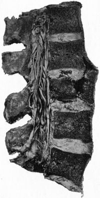 Fig. 207.—Compression Fracture of Bodies of Third and
Fourth Lumbar Vertebræ. Woman, æt. 28, who fell three storeys and
landed on the buttocks.