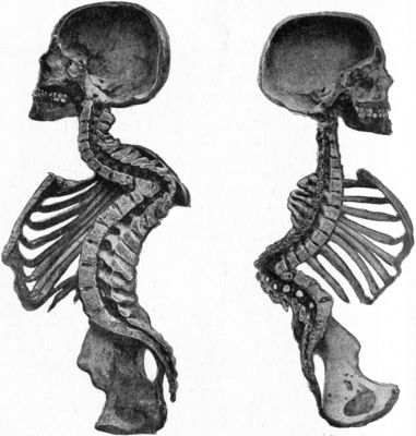 Fig. 211.—Osseous Ankylosis of Bodies (a) of Dorsal
Vertebræ, (b) of Lumbar Vertebræ following Pott's disease. There is
marked kyphosis at the seat of the disease and compensatory lordosis
above and below.