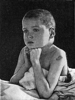 Fig. 214.—Attitude of patient suffering from
Tuberculous disease of the Cervical Spine. The swelling on the left
side of the neck is due to a retro-pharyngeal abscess.