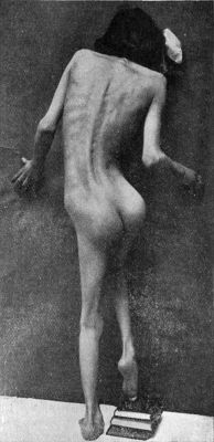 Fig. 224.—Scoliosis following upon Poliomyelitis
affecting right arm and leg.