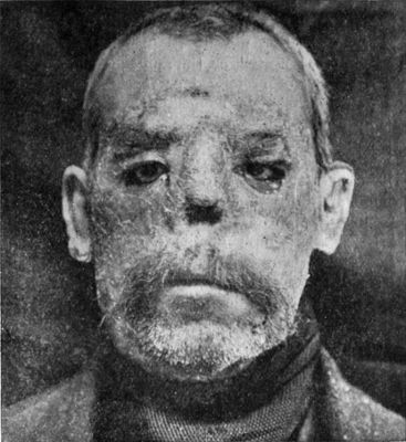 Fig. 237.—Illustrating the deformities caused by Lupus
Vulgaris, which dated from adolescence.