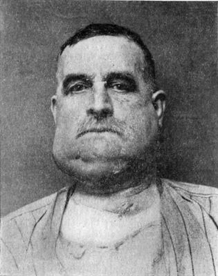 Fig. 244.—Recurrent Epithelioma in Glands of Neck
adherent to mandible.