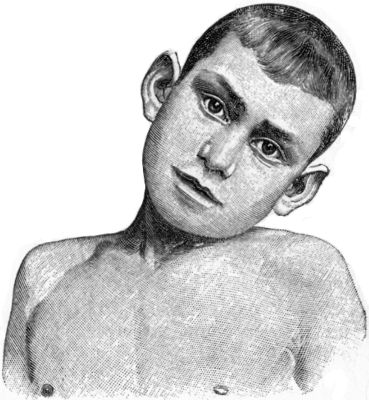 Fig. 270.—Transient Wry-neck, which came on suddenly
after sitting in a draught, and passed off completely in a few days.