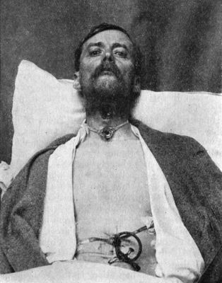 Fig. 273.—Recovery from Suicidal Cut-throat after low
tracheotomy and gastrostomy.