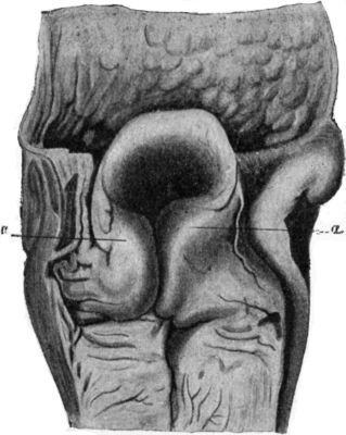 Fig. 287.—Larynx from case of sudden death, due to
œdema of ary-epiglottic folds, a, a.