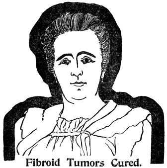 Fibroid Tumors Cured