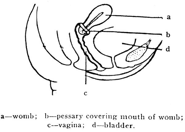 a—womb; b—pessary covering mouth of womb; c—vagina;
d—bladder.