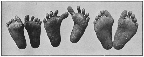 Deformed feet of Bontoc men