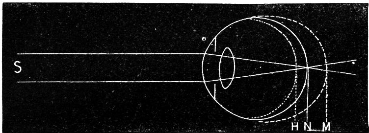 Fig. 51.--The Different Shapes of the Globe of the Eye.