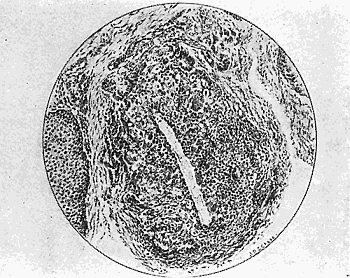 41b. Section through one of the nodules showing the caterpillar
hair. De Schweinitz and Shumway.