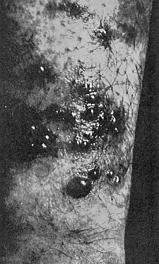 43. Effect of the harvest mites on the skin of man. Photograph by
J. C. Bradley.