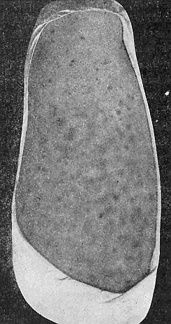 68. Melanoderma caused by the body
louse. From Portfolio of Dermochromes,
by permission of Rebman
& Co., New York, Publishers.