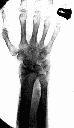 Fig. 6.—Radiogram of a man aged seventy-five, showing calcification of both radial and
ulnar arteries.