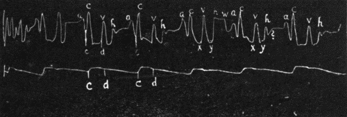 Fig. 37.—Jugular and carotid tracing from a normal individual with a well-marked
third heart sound showing a large "h" and a smaller pre-auricular wave "w." ? indicates
a small wave in mid-diastole following the "h" wave, occasionally found though
perhaps an artefact. (After Hirschfelder.)