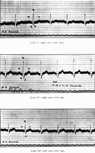 Fig. 39.—Normal electrocardiogram. (After Hart.)