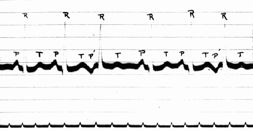Fig. 45.—Electrocardiogram showing auricular extrasystoles (P). (Courtesy of Dr. G. C.
Robinson.)