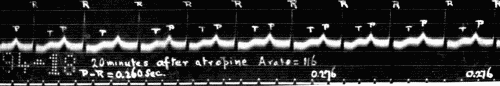 Fig. 47.—Electrocardiogram showing delayed conduction (lengthening of P-R interval).
These P-R intervals are quite regular. When irregular there is apt to be extrasystole
of ventricle or occasional blocking of impulse going to ventricle. (Courtesy of
Dr. G. C. Robinson.)